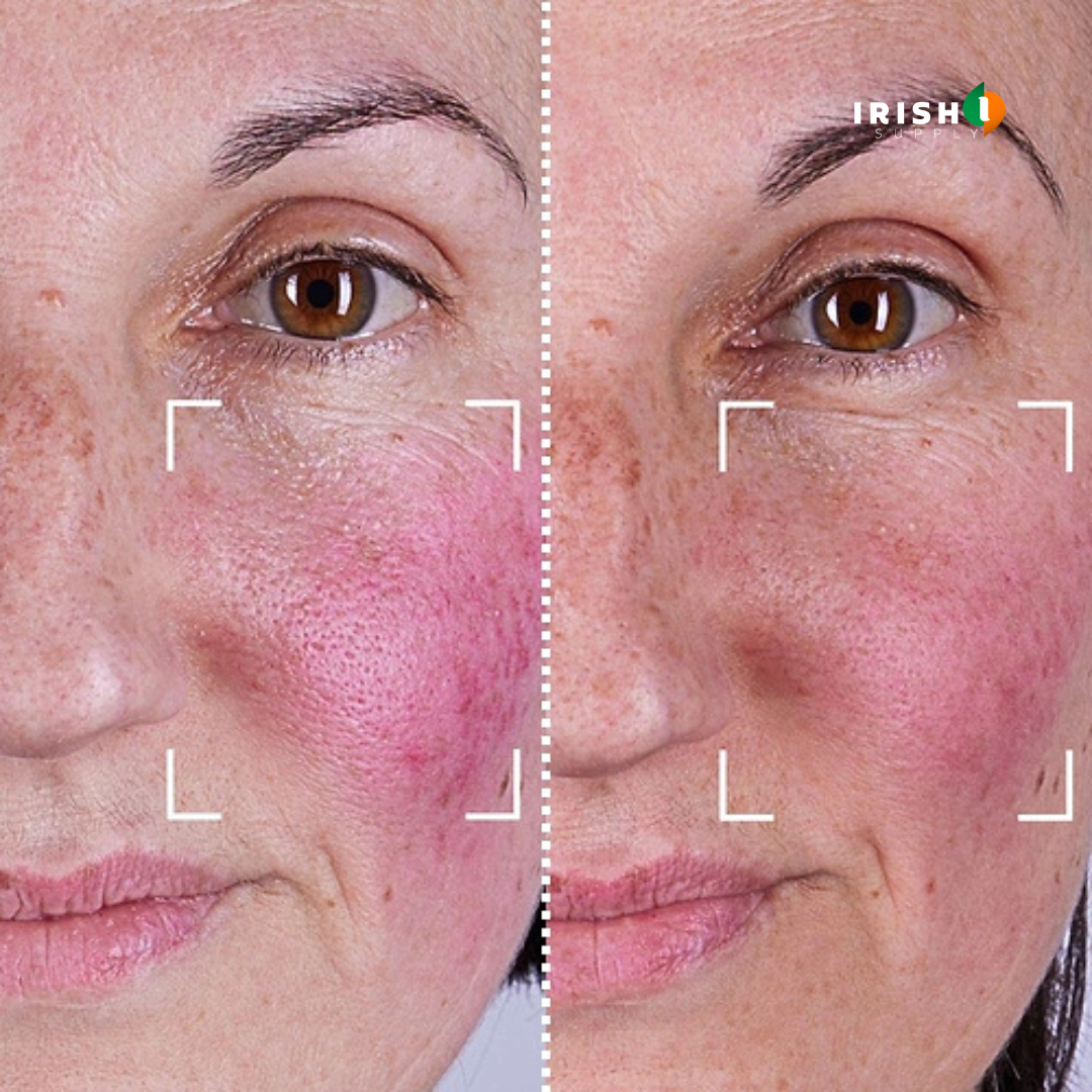 GLOWFORMA 7 LED Light Therapy Skin Rejuvenation Silicone Mask